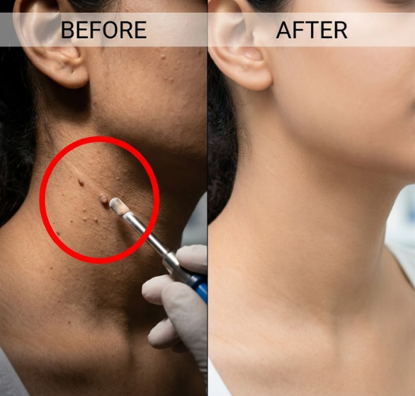 Cryosurgery